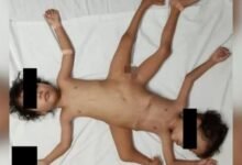 انڈونیشیا میں 3 ٹانگوں والے جڑواں بچوں کی پیدائش