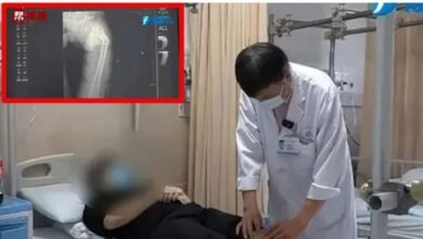 کھانسی سے 35سالہ چینی شخص کی ران کی ہڈی ٹوٹ گئی، ڈاکٹرز حیران